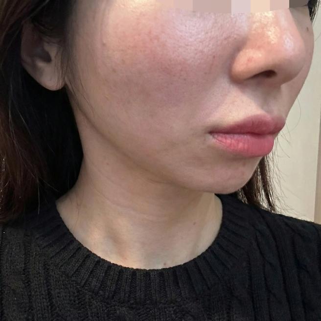 여드름 흉터 고민이라 쥬베룩이랑 연어주사 같이 맞아봤어요!