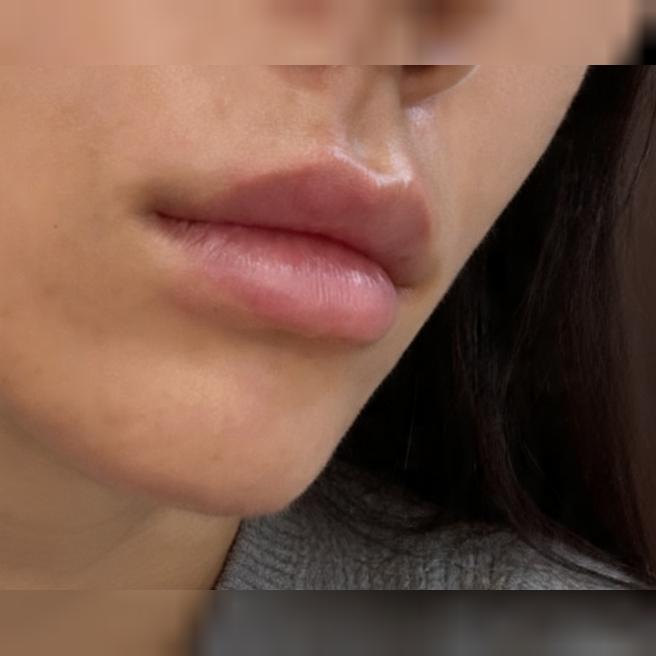 자연스러운 입술 볼륨 원해서 입술필러 받아봤어요~