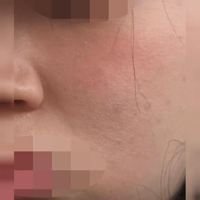 피부 당김 때문에 받았는데 만족스러워서 재방문 예정이에요!