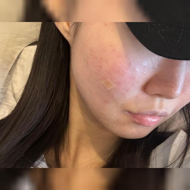 곧 결혼식 앞두고 왔는데 수면이라 편하게 할 수 있었고, 예산 안에서 필요한 시술만 추천해주셔서 좋았어요!