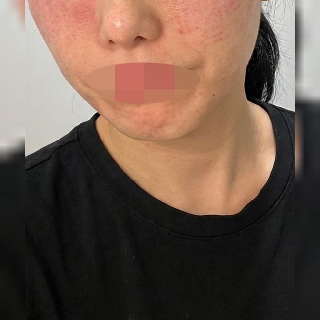 팔자주름 고민으로 쥬베룩볼륨 받아봤어요~!