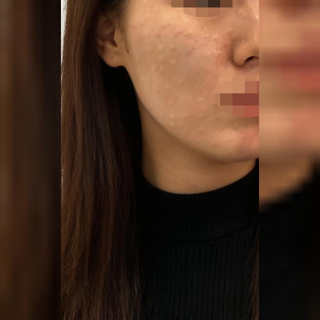 모공이랑 피부결 고민으로 스킨보톡스 받았는데 만족이에요 ㅎㅎ