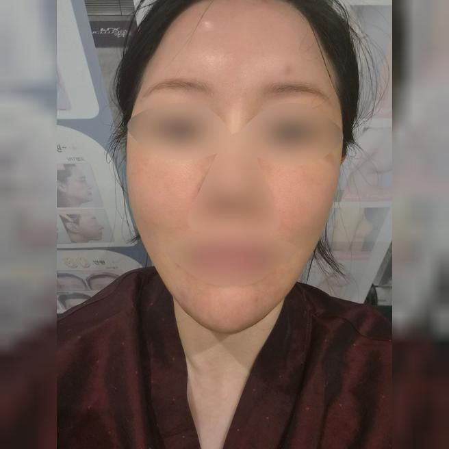모공 고민으로 포텐자 효과 좋다길래 이 병원 선택했어요~