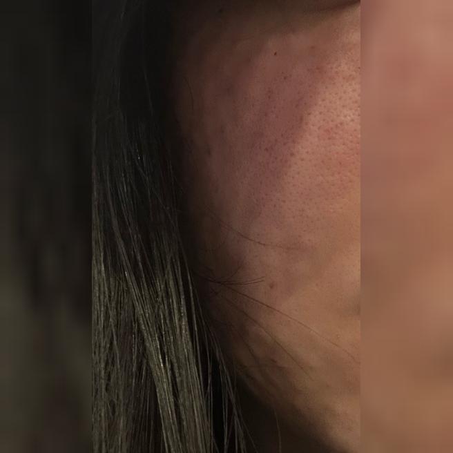 리쥬란이랑 스킨보톡스 같이 받았는데 수면이라 편했어요!
