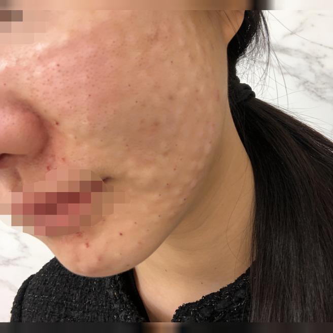 트러블 반복돼서 쥬베룩 받았는데 피부 진정되는 느낌이에요 ㅎㅎ