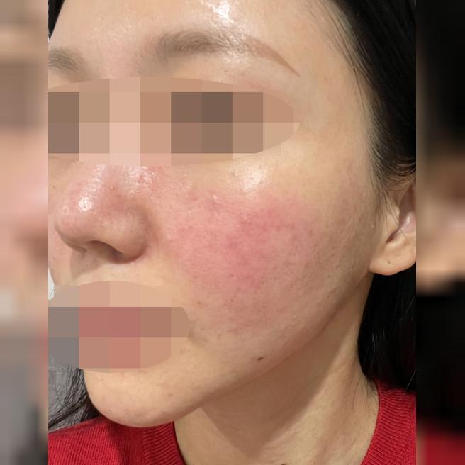 속건조랑 화장 잘 먹는 피부 유지하려고 리쥬란 또 맞으러 왔어요~