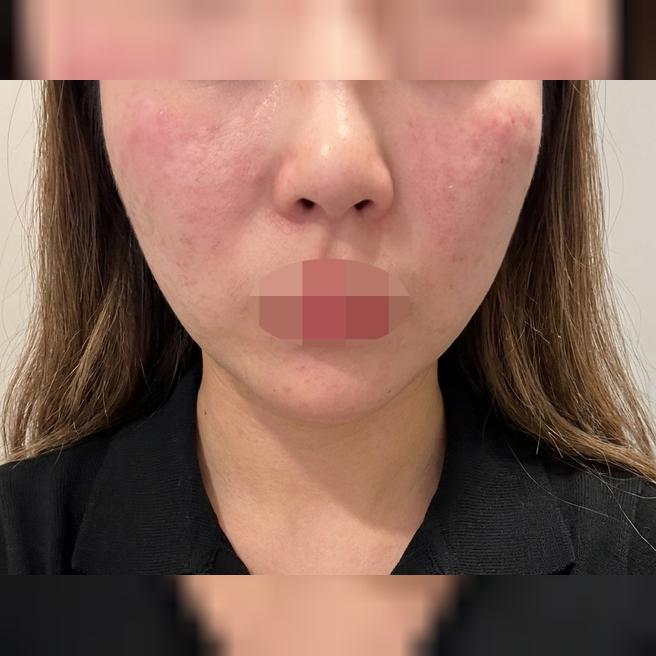 건조하고 뒤집어진 피부 고민, 수면 리쥬란으로 잡았어요~