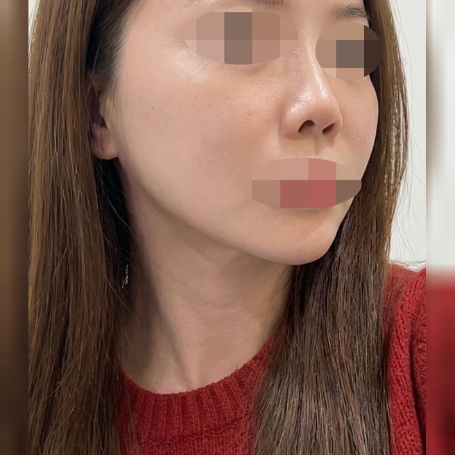 턱선 처짐 때문에 온다리프팅 받았는데 만족인 것 같아요~!