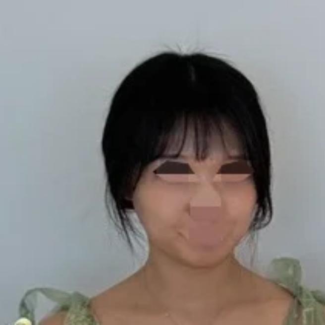 리쥬란힐러 당일 수면마취로 편하게 시술받았어요ㅎㅎ