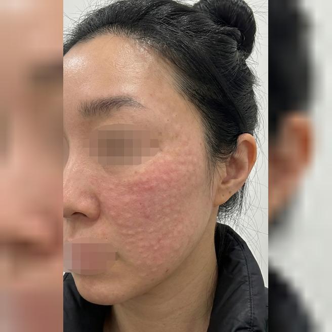   리쥬란 만족해서 또 왔는데 엠보 촘촘해서 좋았어요~ 재방문인데 역시 잘 해주셔서 좋아요!