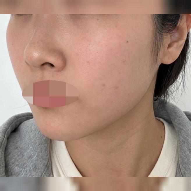 마취로 부담 없이 볼링크 첫 리프팅 받아봤어요!