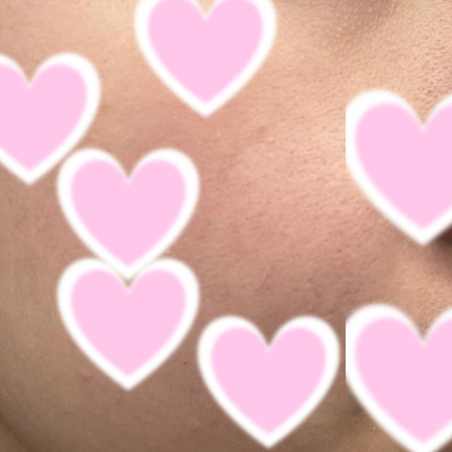 인모드 7일차, 얼굴 라인이 한결 깔끔해진 것 같아요