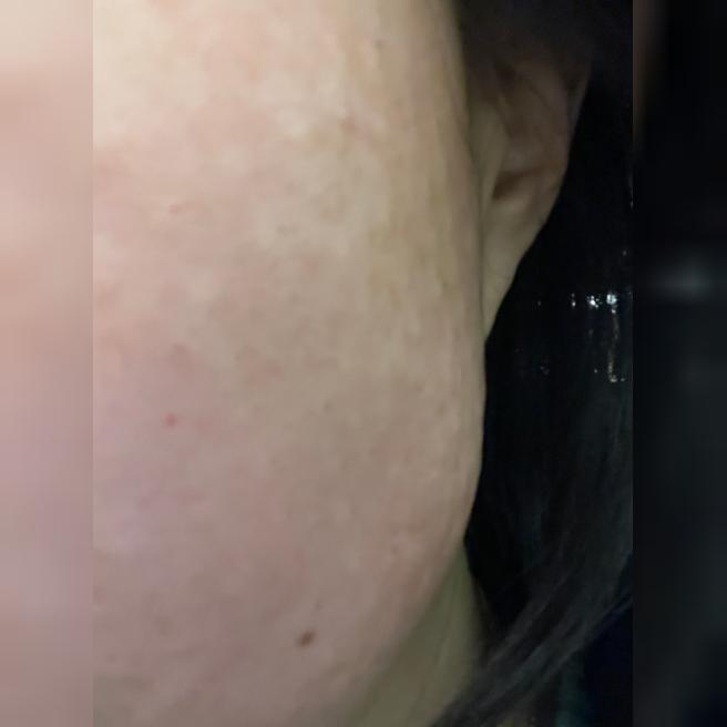 리쥬란 맞고 2일차, 아직 울퉁불퉁하지만 기대중 