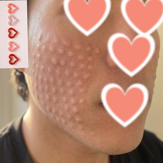 남자도 리쥬란 맞나요? 당일 후기 솔직하게