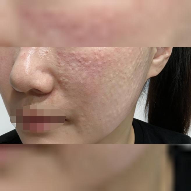 미간주름 고민에 건조함까지, 보톡스+리쥬란 동시에 받고 왔어요!!
