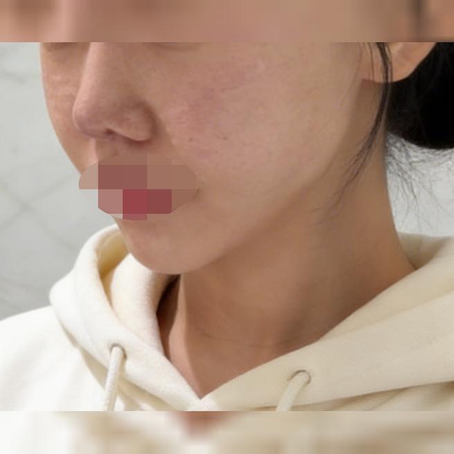 모공 늘어지고 피부결 거칠어진 것 같아서 리쥬란 받으러 방문했어요!