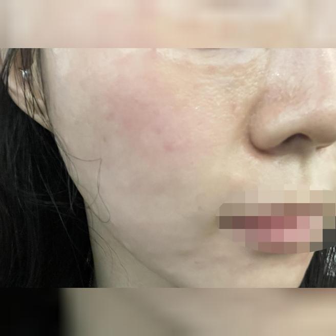 눈 앞에서 정품 인증해 주시고 수면으로 편하게 받고 왔어요~!!