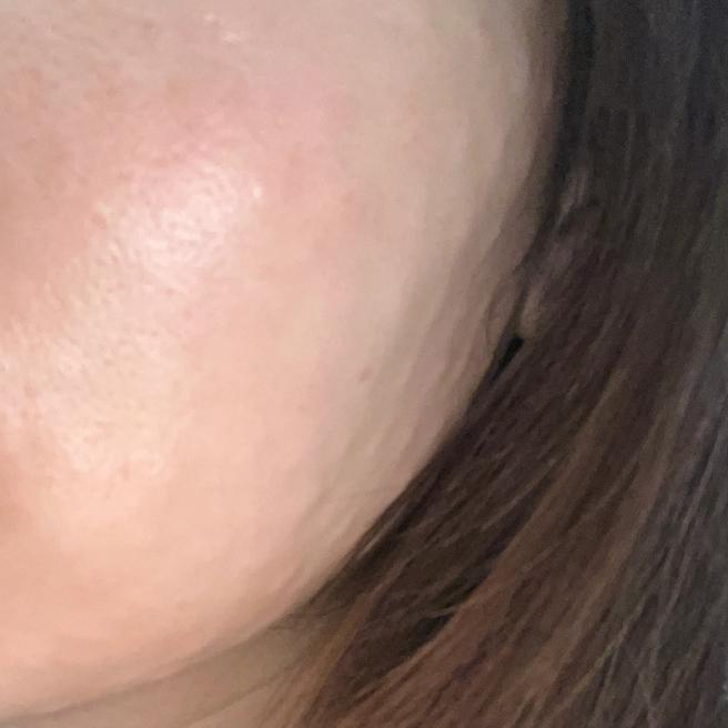 일본에서 방문해서 받은 리쥬란 힐러, 진행 속도까지 마음에 들었어요~!!