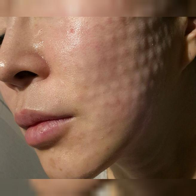 수면마취라 통증 하나도 없었어요~ 간편하고 좋았습니당ㅎㅎ