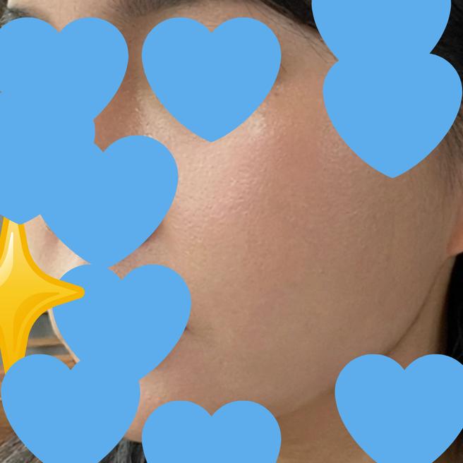 울쎄라 2주 후 후기, 자연스러운 리프팅 효과가 보여요