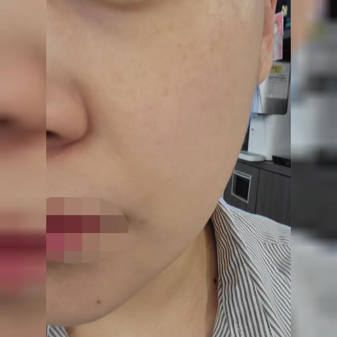 써마지 받고 나니 라인이 정리된 것 같아서 재방문 의사 있어요~