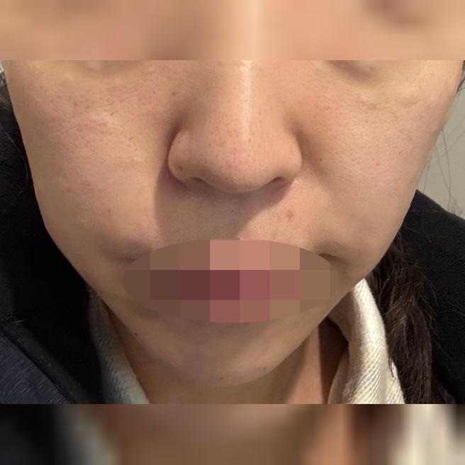 피부 처져서 써마지 받았는데 친절하고 좋은 것 같아요 ㅎㅎ