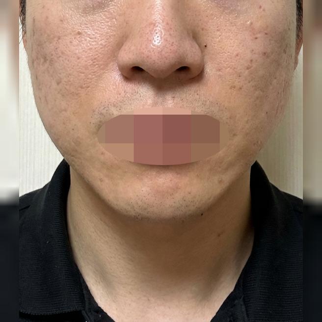 탄력 떨어지는 게 느껴져서 지인 추천으로 리쥬란 드디어 받아봤습니다~
