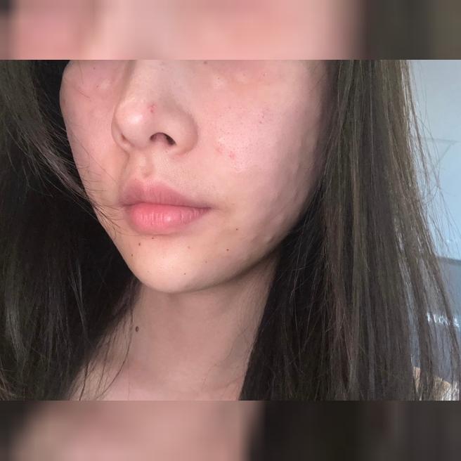 서울아이 리쥬란 당일 !! 꼼꼼하게 시술해주셨어요 :)