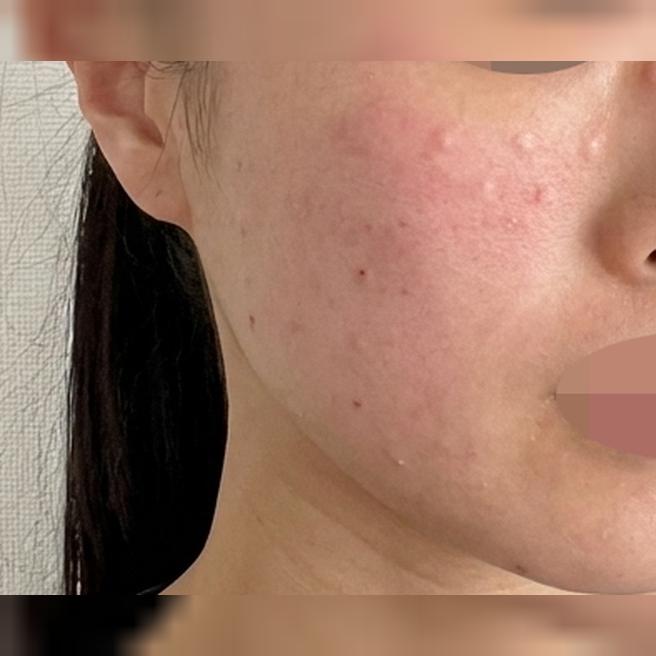 피지 분비 고민에 스킨보톡스, 수면으로 통증 없이 받았어요ㅎ
