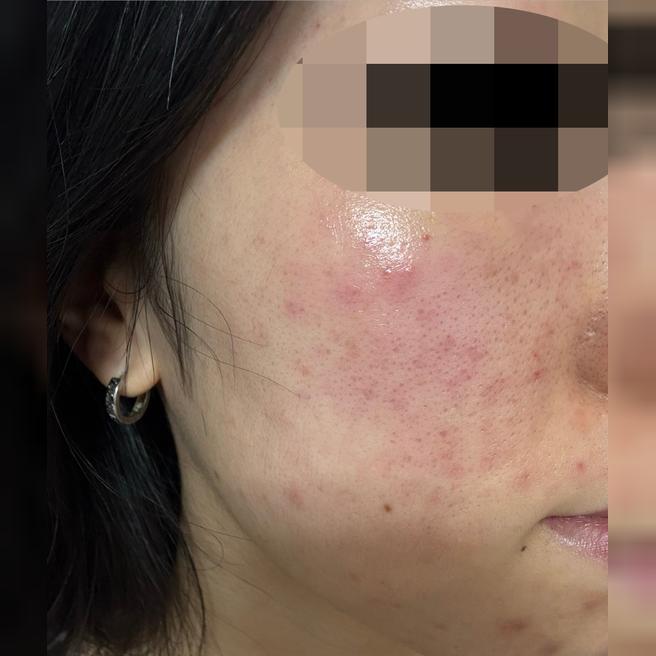 속건조 심해서 리쥬란힐러 받았는데 피부에 광 도는 것 같아요!!