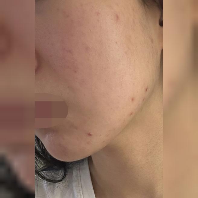 트러블 잡고 결까지 살리는 엑소좀, 진짜 추천드려요~!!