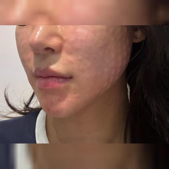 친절한 상담에 확실한 엠보까지, 리쥬란 가성비 최고예요~