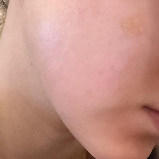휴에 엑소좀이랑 리투오 같이 받고 왔어요, 효과 기대 중