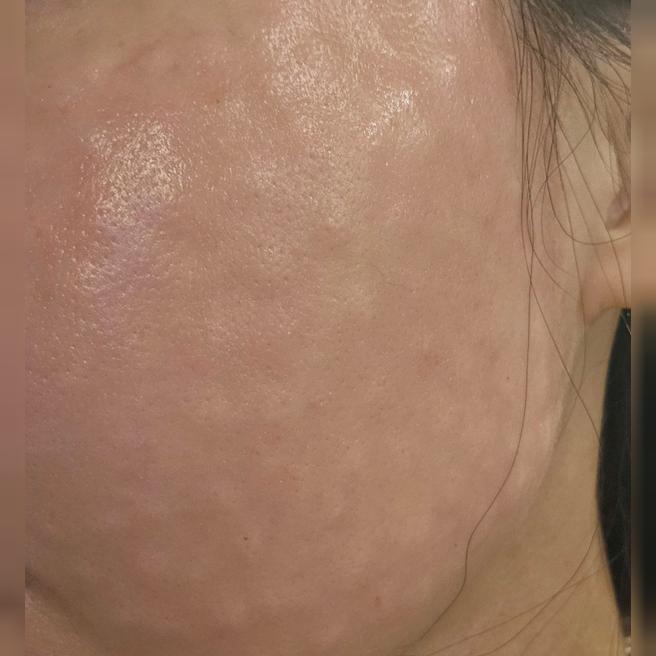 일반 리쥬란보다 안 아프고 빠르게 잘 됐어요!