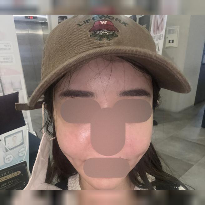 일주일에 한 번 받는데 인모드로 바로 얼굴 작아져서 가성비 갑이에요!