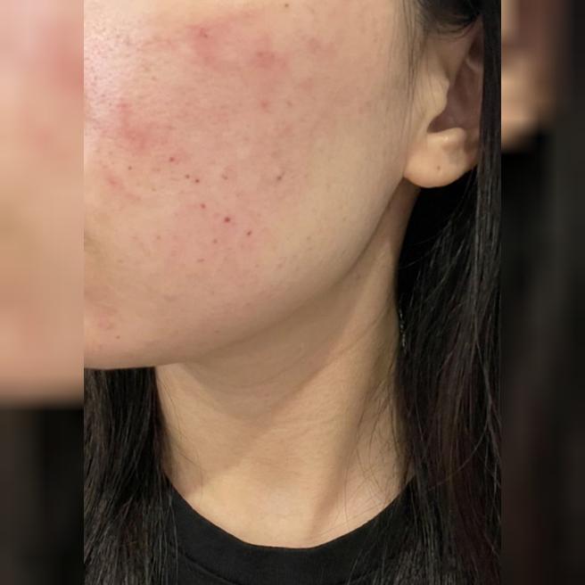 엠보 촘촘하게 잘 올라온 리쥬란, 다음에도 또 방문할 예정이에요ㅎㅎ
