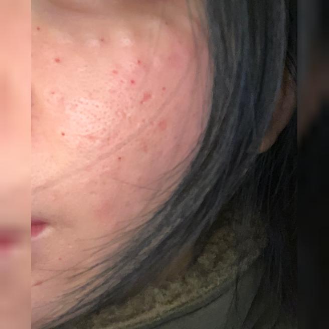 흉터모공 고민으로 받았는데 만족해서 또 올 것 같아요!