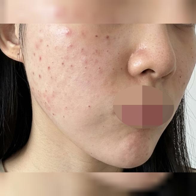 리쥬란 받았는데 엠보 빵빵하게 잘 올라와서 만족이에요 ㅎㅎ