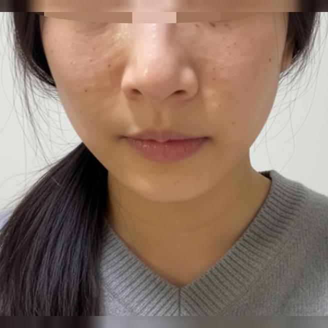 꼼꼼한 시술에 너무 만족! 리쥬란 잘 받고 왔어요