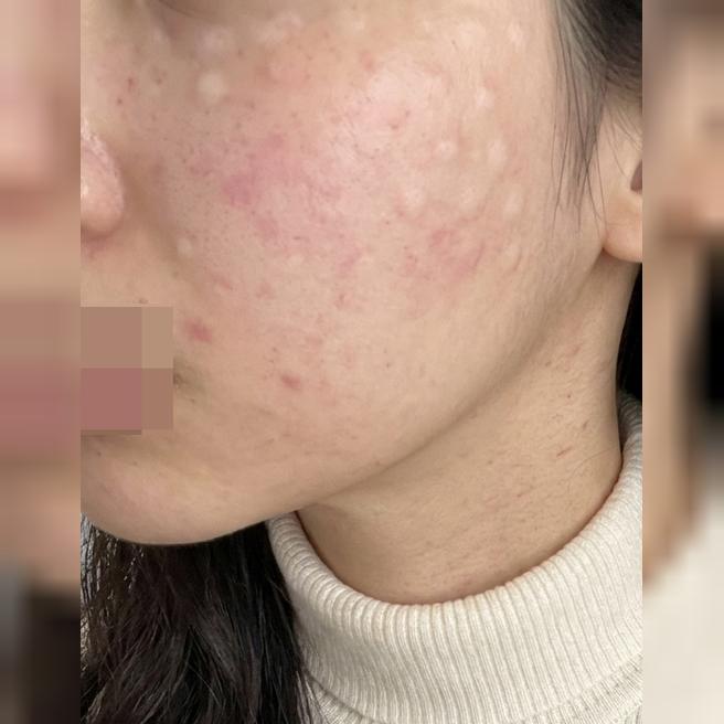 칙칙함이랑 모공·속건조 고민으로 시작한 리쥬란, 결심하길 잘했어요!