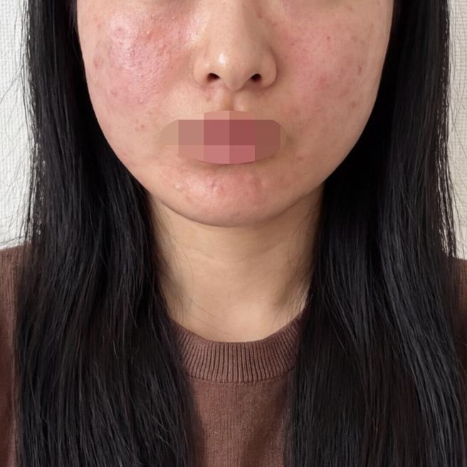 계절 바뀌자마자 피부 당김 심해져서 PRP 받았습니다~