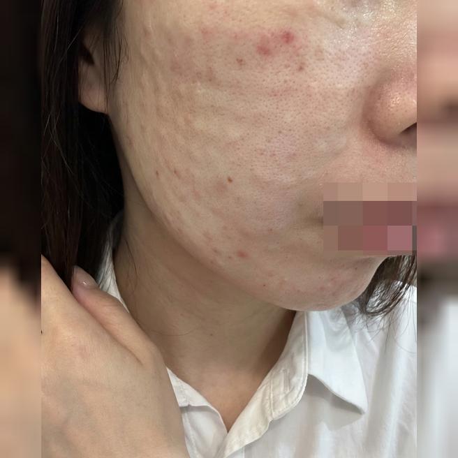 일본어 가능한 스태프까지! 안심하고 받은 리쥬란 후기예요~