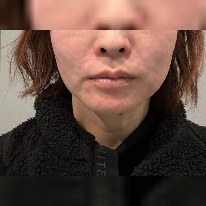리프팅 받으러 갔는데 일본어 상담 가능해서 좋았어요 ㅎㅎ