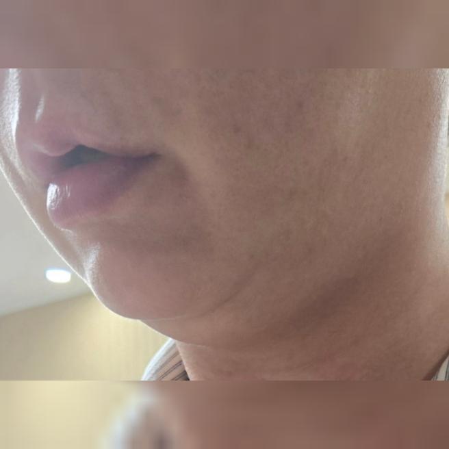 온다리프팅 받았는데 효과 바로 나타나서 좋아요 ㅎㅎ