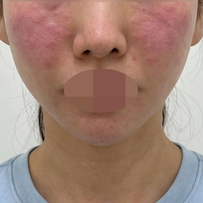 수면 합리적 가격에 전문의까지! 미루던 리쥬란 드디어 받았어요~