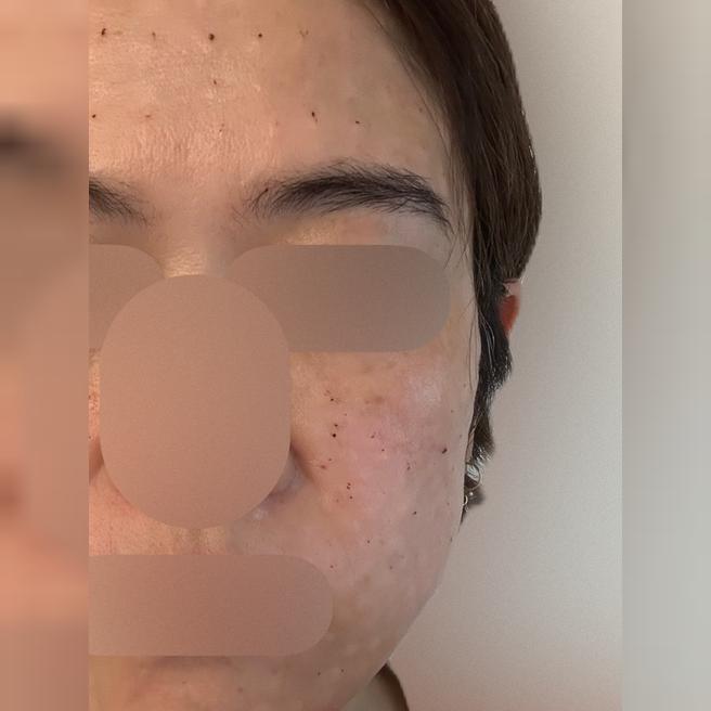 가격이랑 접근성 보고 방문했는데 수면 리쥬란 너무 만족이에요!