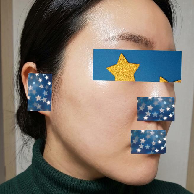 얼굴 전체 보톡스 3주 후기 | 찡그려도 주름이 덜 잡혀요