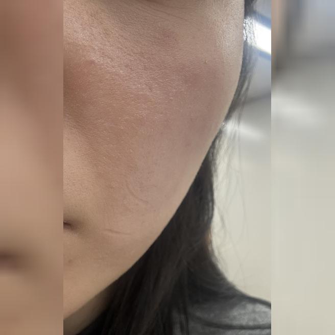 추가 결제 없이 리쥬란 받아서 좋은 것 같아요, 3회차까지 해볼 예정이에요!