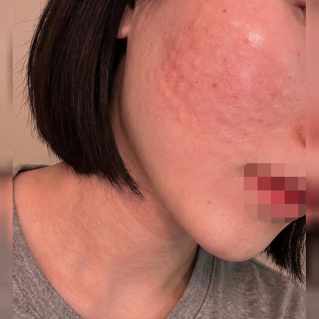 리쥬란 받았는데 수면이라 편하고 대기도 짧아서 좋은 것 같아요!