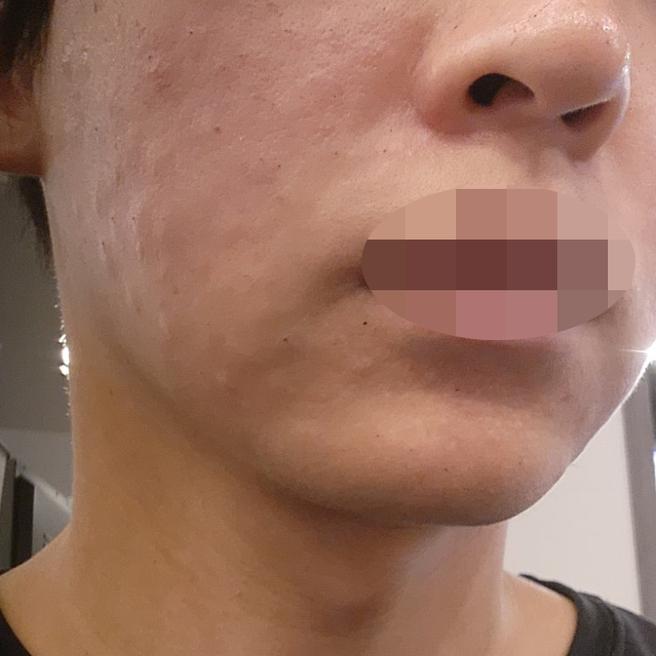예방 목적으로 수면 리쥬란, 통증 없이 편하게 받았어요!